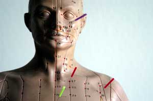 Körperakupunktur